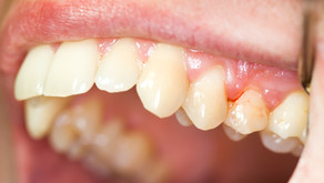 Why Your Gums Bleed After You Brush Your Teeth
