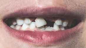 Have You Heard Of Tooth Loss Caused By Diabetes?