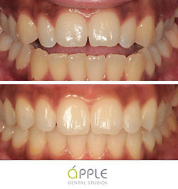 invisalign-case-3.jpg