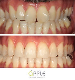invisalign-case-1.jpg