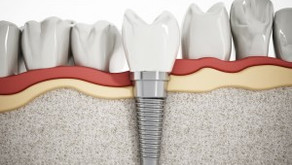 What to Expect During a Dental Implant Procedure