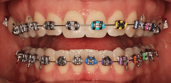 Metal braces cheap