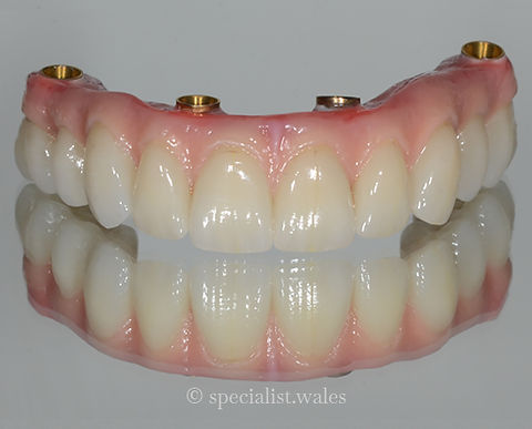 All Of The Upper Teeth