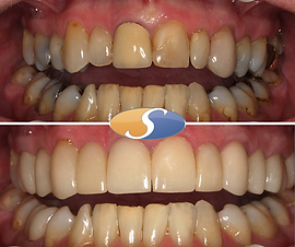 Smile makeover - all-ceramic crowns-3