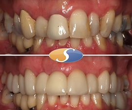 Smile makeover - all-ceramic crowns