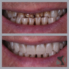 Smile Design - Reconstruction.jpeg