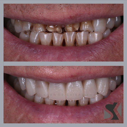 Smile Design - Reconstruction.jpeg