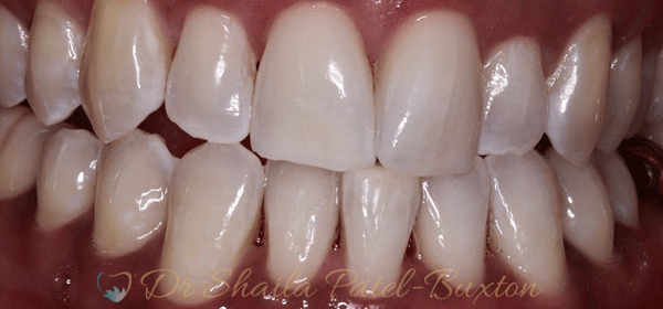 teeth-whitenig-after.gif