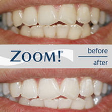 philips-zoom-2