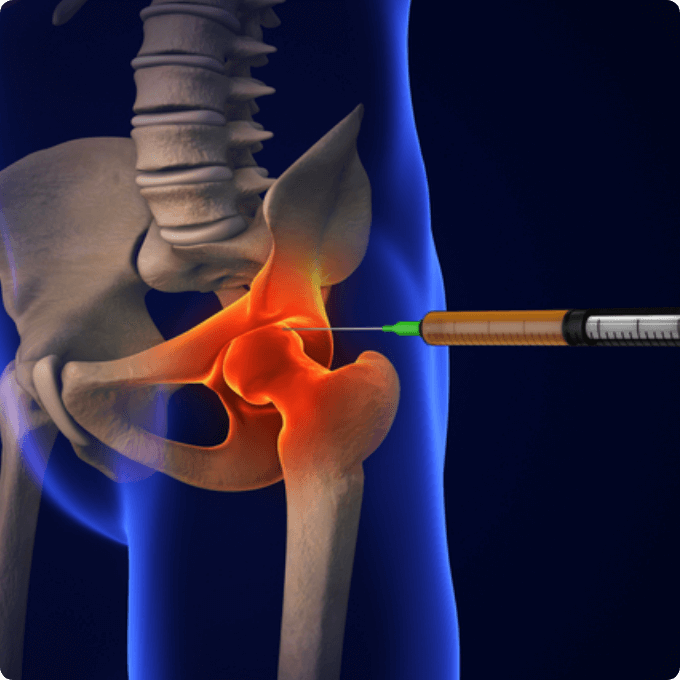 Joint steroid injection consultation and treatment for shoulder, knee, or hip in London