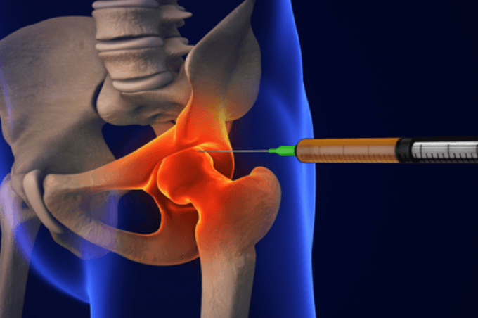 My Harley Medical Hip Injection.png