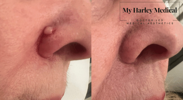 Doctor-led minor surgical mole removal and histology examination in London