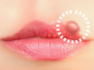 Elimina los herpes labiales