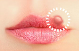 Elimina los herpes labiales
