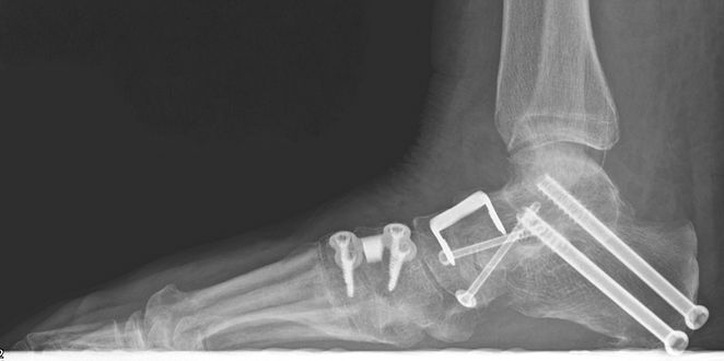 Progressive collapsing foot deformity treated with fusion and osteotomy by Dev Mahadevan