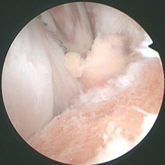 Arthroscopic Haglund resection