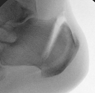 Zadek osteotomy