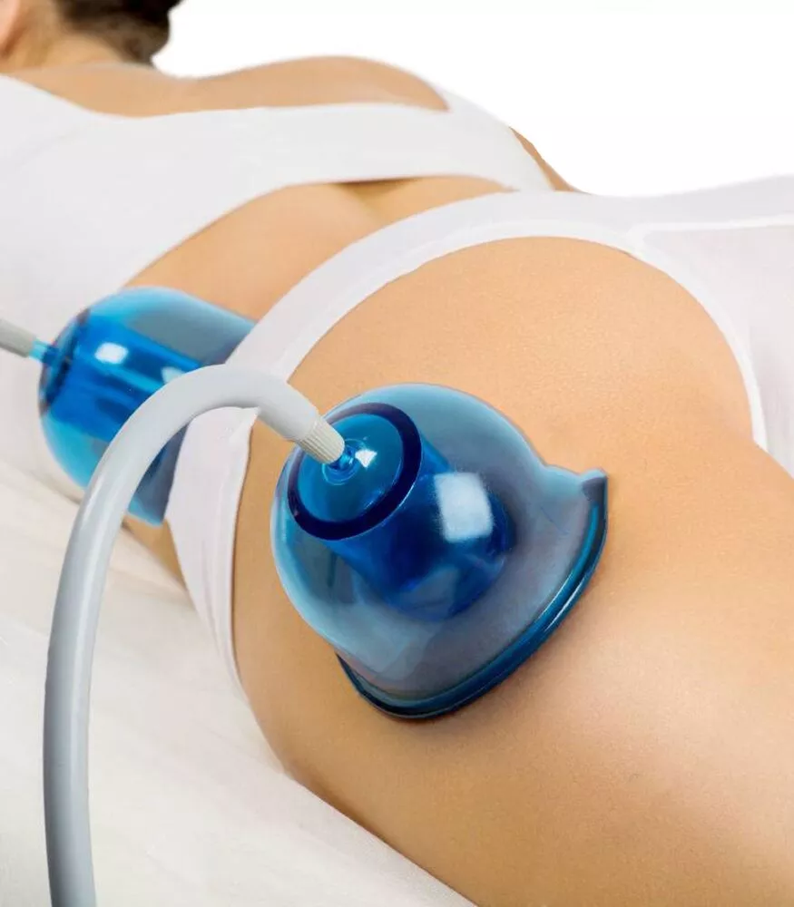 Vacuum-Therapy-for-Buttocks.jpg.webp