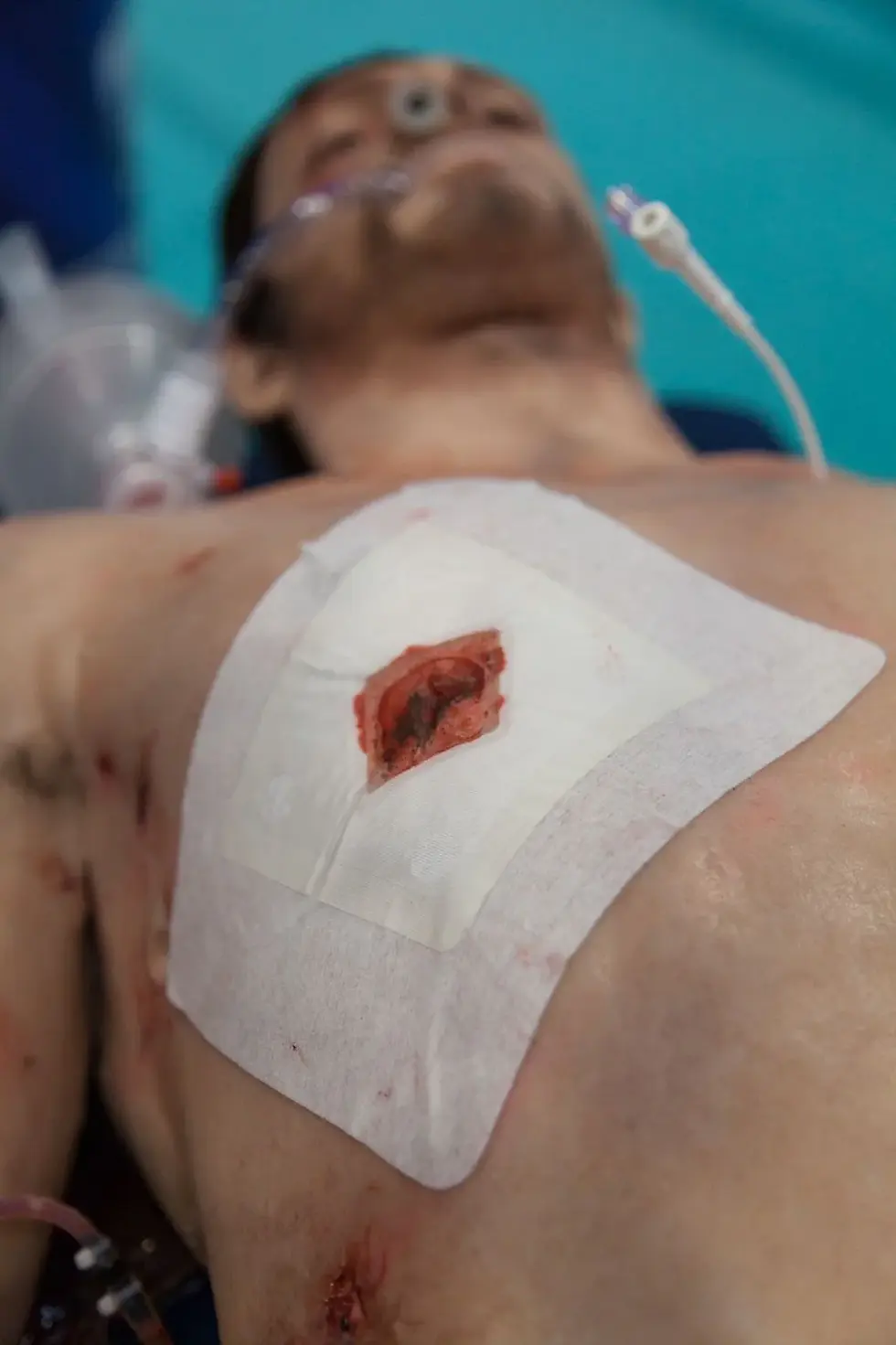 Miniatura: Russell™ Chest Seal