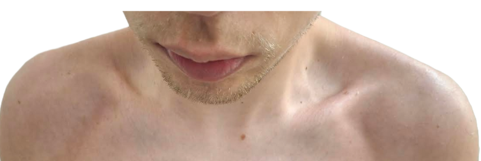 A close-up of a young adult’s chest and shoulders showing smooth, healed skin after natural treatment for sunburn with essential oils and hydrosols.