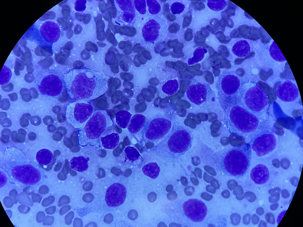 Cytology from mammary tumor in a sugar glider