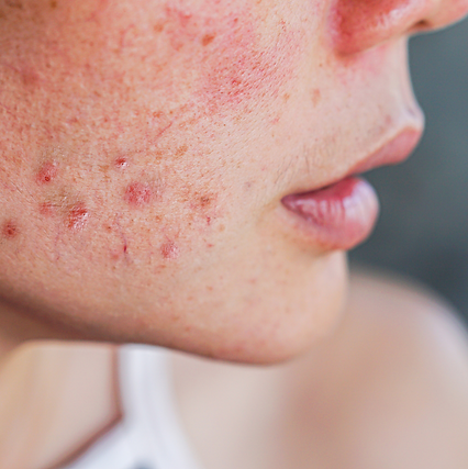 treatment for acne