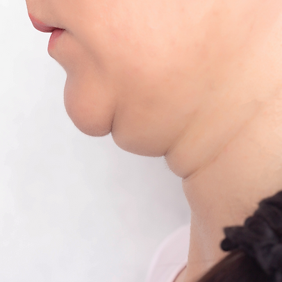 double chin painless treatment