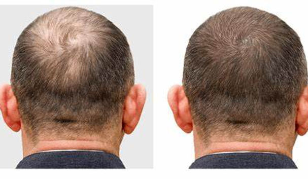 hairloss treatment in colorado