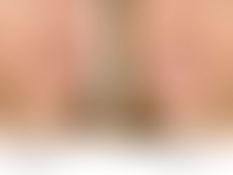 porcelain veneers