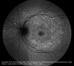 Stargardt-Disease_AF-.png
