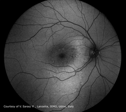 Central-Serous-Chorioretinopathy_AF-.png