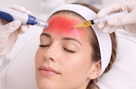 Vampirlift Behandlung mit PRP und Microneedling im Gesicht