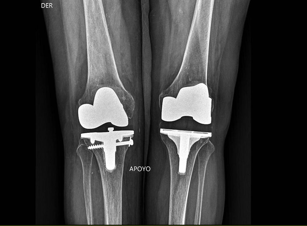 Fractura introperatoria tibia_edited.jpg