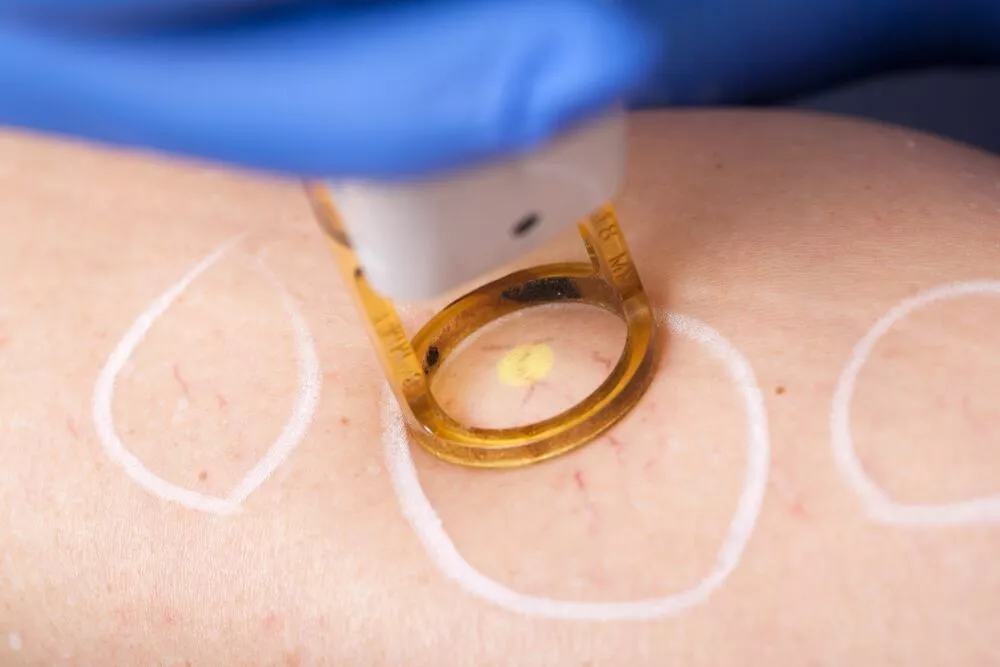spider-vein-treatment-patient.webp