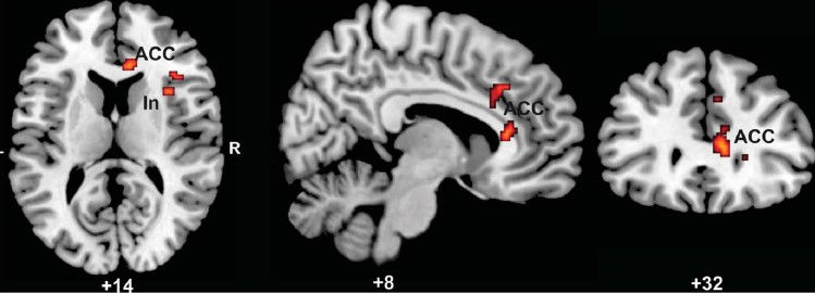Areas of a masochist's brain activated by masochistic images