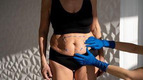 Tummy Tuck Surgery in London: What to Expect, Costs and Recovery (2026 Guide)