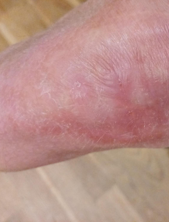 DAY 7 - WOUND - MISFITTED PROSTHESES - DAY 7 - HEALED WOUND.jpg