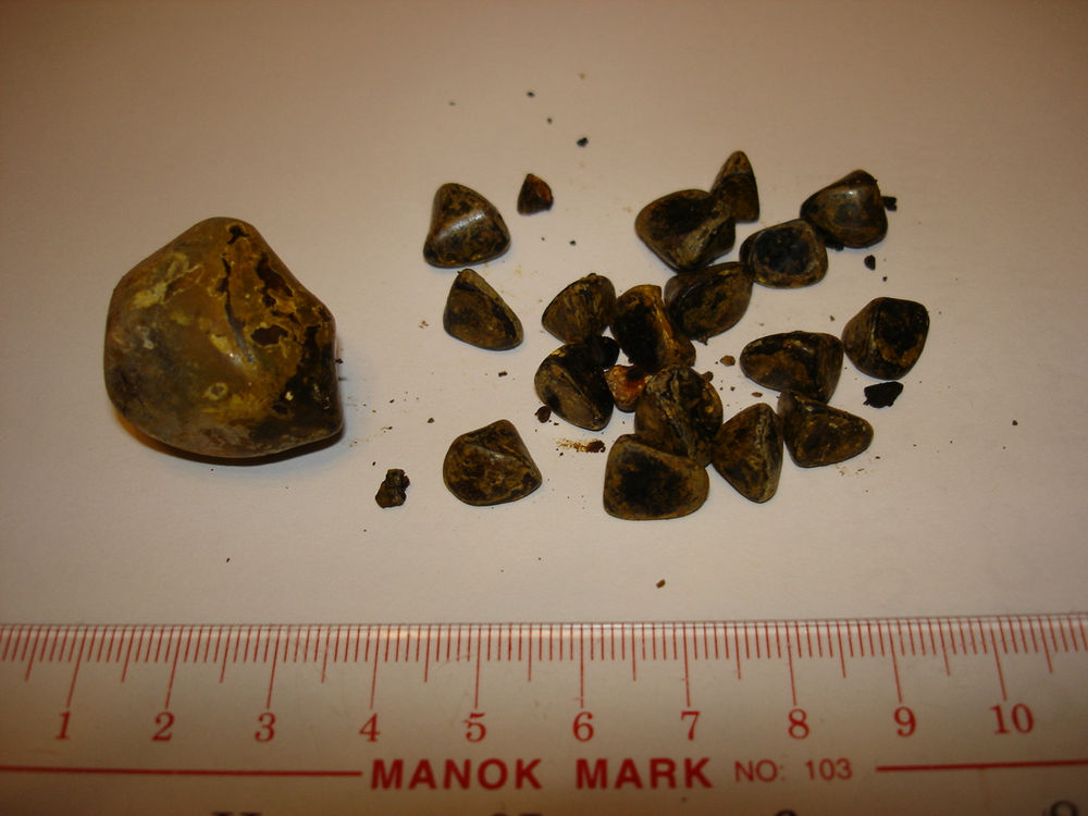 How Are Gallstones Formed? Symptoms and When Is It Time To See The Doctor?