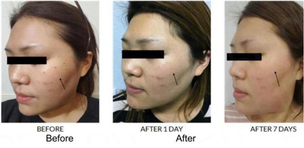 Thumbnail: MAXXIMUS SLT-NdYAG mini