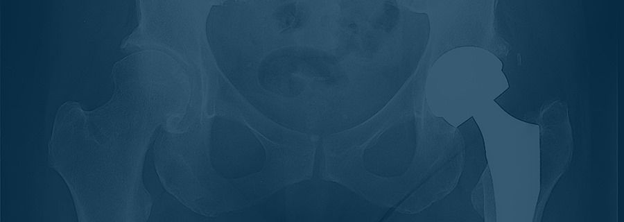 Anterior Hip Replacement