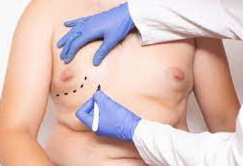 gynecomastia - drdanino - montreal.jpeg