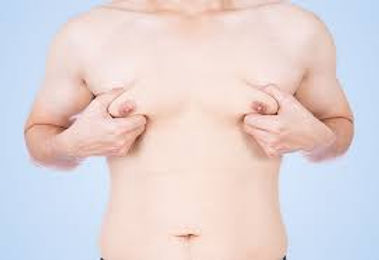 gynecomastia - male breast reduction - montreal.jpeg