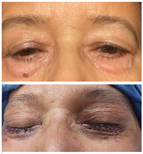 lower lid blepharoplasty.jpg