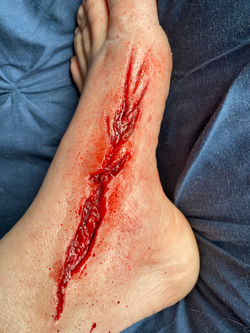 Injury