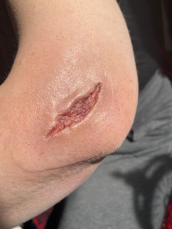 Injury
