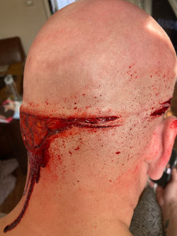 Injury
