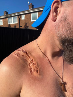 Injury