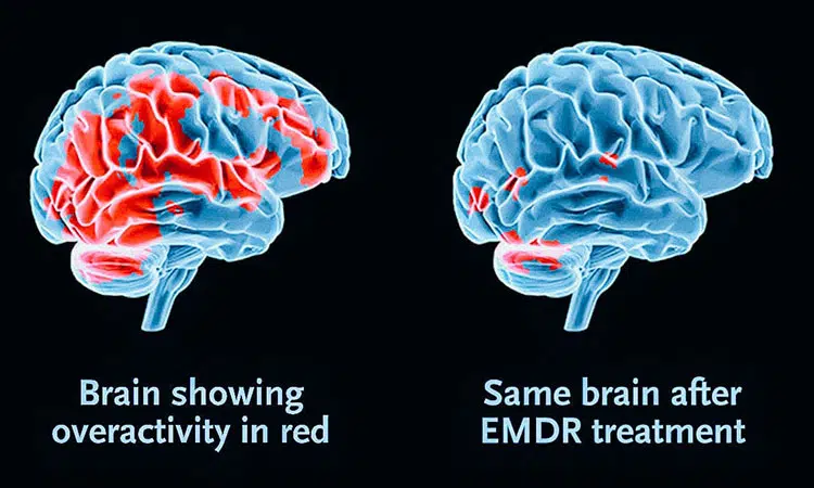 EMDR Therapy in Vancouver