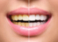 teethwhitening.jpeg