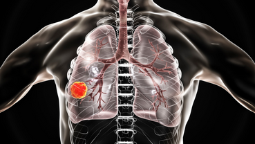Targeted Therapies in NSCLC: Current Landscape and Emerging Agents
